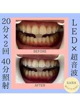 ココティ ホワイトニング(Cocotii)/お客様ビフォーアフター