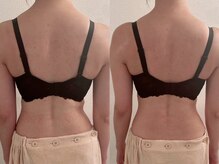 美人バスト 横浜店/バストアップ症例/育乳(6回施術)