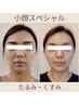 お試し価格【むくみ/丸顔/顔コリ】ベーシックな小顔ケアはこちら