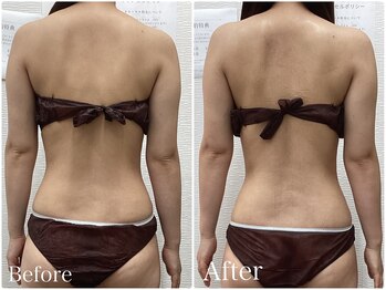 ルピア(L'pur)/肩甲骨周りのビフォーアフター★