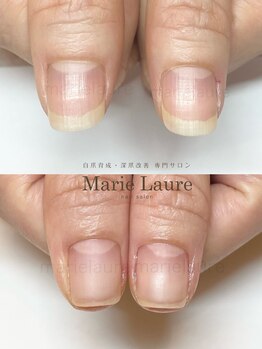 マリーロール 梅田店(Marie Laure)/深爪矯正/自爪育成/自爪風