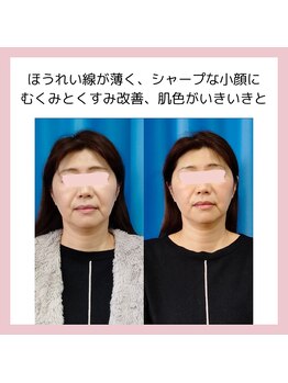 目元 口元のたるみ 眉間シワ改善専門サロン/シャープな小顔になりたい方向け