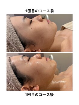 グレッシュ &nbsp;弘前店(Gresh)/【瞬間小顔/リフトアップ】