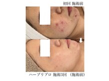 ミベル(MeBell)/【ハーブリプロ】ニキビケアも◎