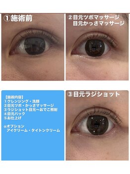 エンフィール(&.Feel)/目元クマ改善