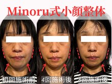 フレキシボディ(FlexiBody)/小顔施術ビフォーアフター #9