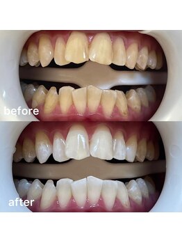 ホワイトニングセンター 京都長岡京店/長岡京・大山崎ホワイトニング