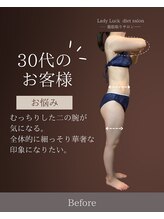 レディラック 大阪梅田本店(Lady Luck)/脂肪冷却コース