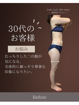 レディラック 大阪梅田本店(Lady Luck)/脂肪冷却コース