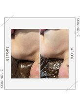 スキンホリック 恵比寿駅前店(SKIN HOLIC)/気になる肩回りもスッキリ！