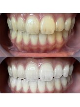 LBSホワイトニング 錦糸町店/ホワイトニングビフォーアフター