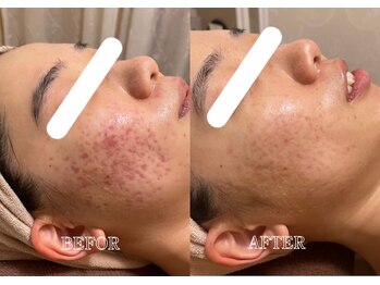 リス ブラン(Lys Blanc)/ハーブピーリング