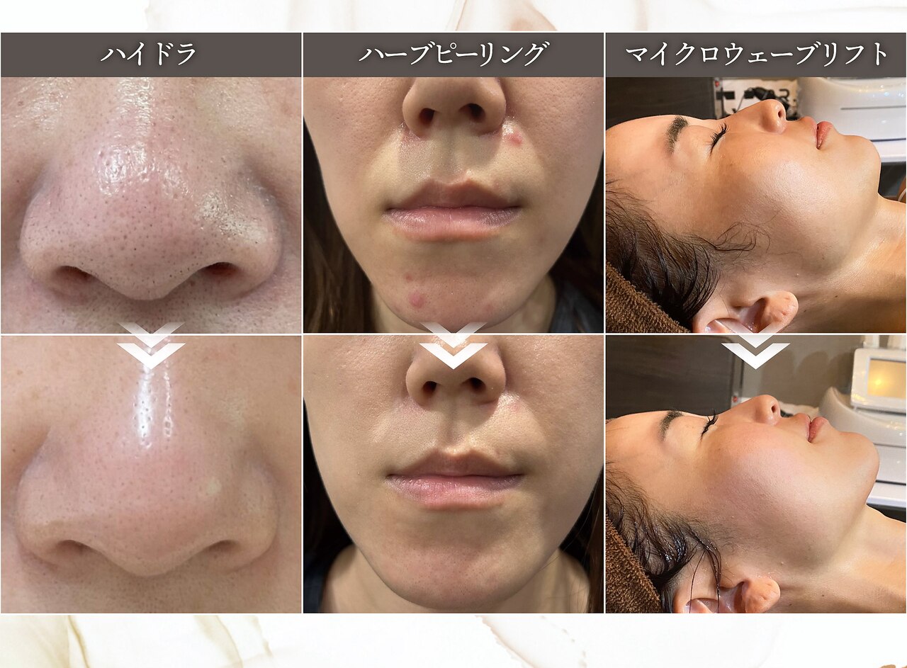 大阪市福島区で毛穴洗浄・毛穴吸引が人気のエステサロン