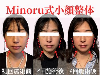 フレキシボディ(FlexiBody)/小顔施術ビフォーアフター #10