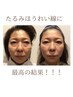【一番人気】小顔矯正＋たるみ改善特化マシン12000円