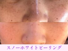 オーシャンブルー 日田店/シミくすみケアスノーピーリング