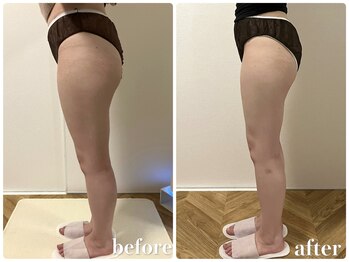 リリィブラン(Lily branc)/【痩身】ヒップ+太もも