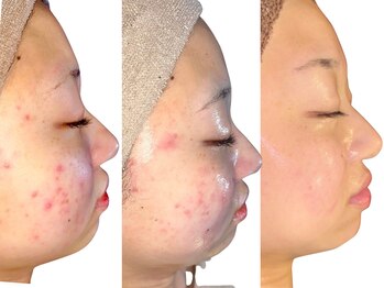 ニコレ(Nicore)/繰り返すニキビケア根本改善