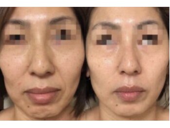 れふぇるん 足利店/ほうれい線&たるみ改善 施術1回