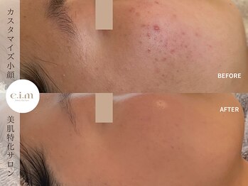 エイム(e.i.m)/10代：ニキビ/毛穴のざらつき