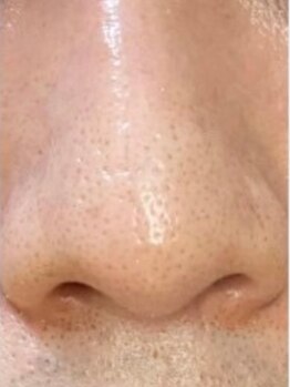 毛穴ケアをしたい