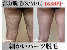 アップパイン(UPPINE)/部分脱毛(S/M/L)¥1,650~