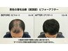 1ヶ月新毛保証コース(スコープ診断込み) 男性限定クーポン！