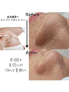 ルミナエステ(LUMINA ESTH)/毛穴/毛穴洗浄/毛穴ケア|症例