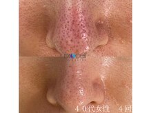 オウジエステサロン(OJIエステサロン)/４０代女性　プロセル4回