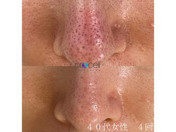 オウジエステサロン(OJIエステサロン)/４０代女性　プロセル4回