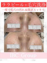 IBC 上大岡店/ララピール×毛穴洗浄