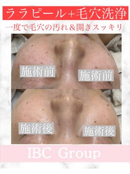 IBC 上大岡店/ララピール×毛穴洗浄