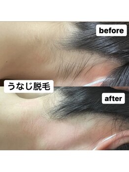 ミノア 大野城店(MINOA)/全身脱毛/うなじ脱毛/ブライダル