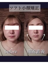 ヘッドラボ(Headlabo★3103)/ソフト小顔矯正