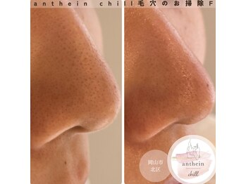 アンテイン チル(anthein chill)/毛穴のお掃除フェイシャル