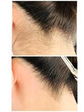 リアン(Rian)/ワックス脱毛／うなじ