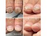【HAND】深爪・ダメージ爪の補修に　爪育成のためのスカルプチュア