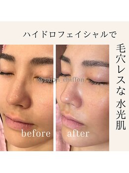 シフォン(Chiffon)/毛穴だけじゃないハイドラ洗浄