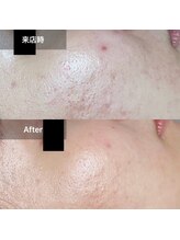 ネオオアシス トウキョウ(ネオOASIS TOKYO)/ハーブピーリング（剥離あり）