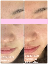 リン(琳 rin)/ラミネーションピール