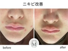 ミヨン(Miyong)/繰り返すニキビケア