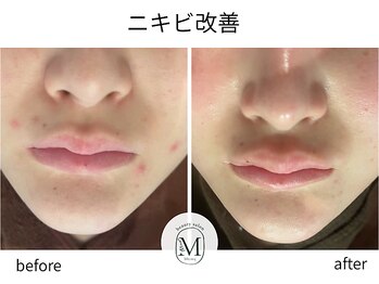 ミヨン(Miyong)/繰り返すニキビケア