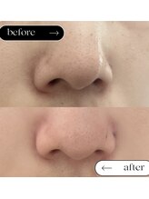 ミィ(miii)/毛穴洗浄でつる艶なお肌へ