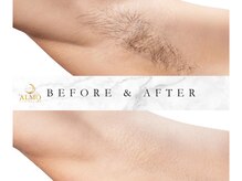 VIO脱毛専門の技術力！デリケートゾーンを知り尽くしたプロケア