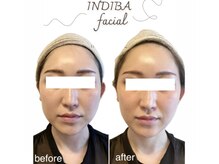 インディバ ベース(INDIBA BASE)の雰囲気（高周波が加齢の原因にアプローチ！ハリ艶UPで内側から元気な肌へ）