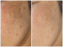 ルポ 鶴見(Repos)/シミケアもプラズマで改善★