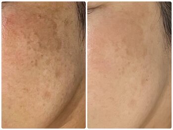 ルポ 鶴見(Repos)/シミケアもプラズマで改善★