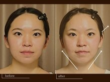 クレスト(CREST)/ビフォーアフター【小顔名古屋】