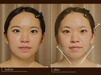 クレスト(CREST)/ビフォーアフター【小顔名古屋】