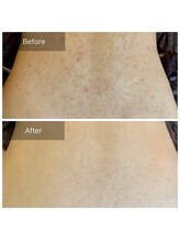 エミルカ 岡山店(EMILUCA)/お背中の施術事例